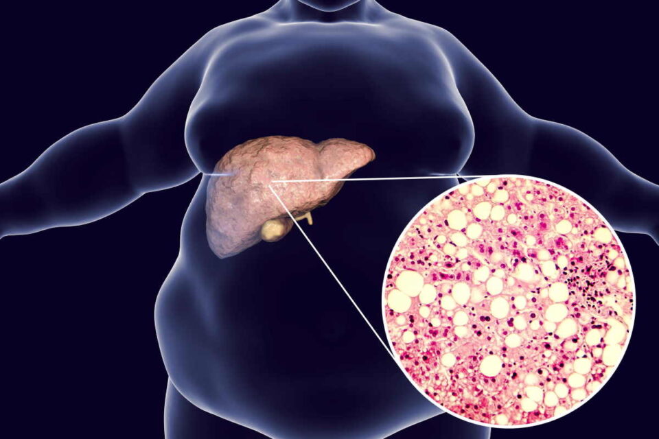 La steatosi, ovvero l'accumulo di grassi nel fegato, è anche definita "fegato grasso"