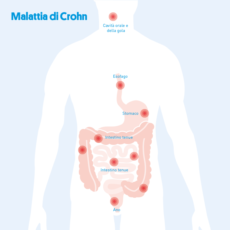 Punti in cui il morbo di Crohn si manifesta